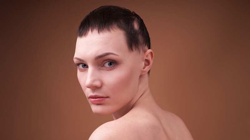 A young woman with alopecia (Image: Getty Images)