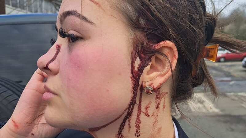 Chloe Fisher, 15, after she was stabbed in the head with scissors (Image: Jay Fisher / SWNS)