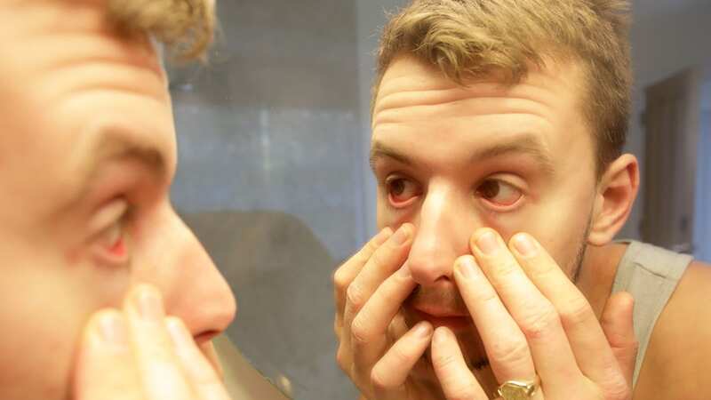 A man looking at his eyes in a mirror [file image] (Image: Getty Images)