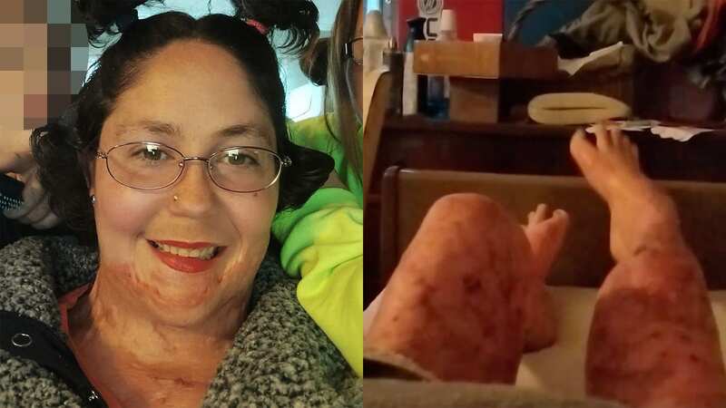 Chassidy suffered horrendous burns across her body (Image: Chassidy Taylor/Facebook)