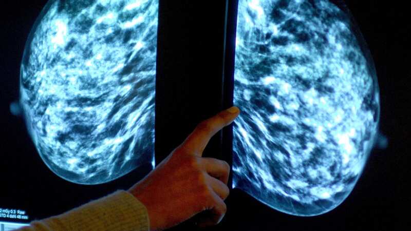 A mammogram showing a woman