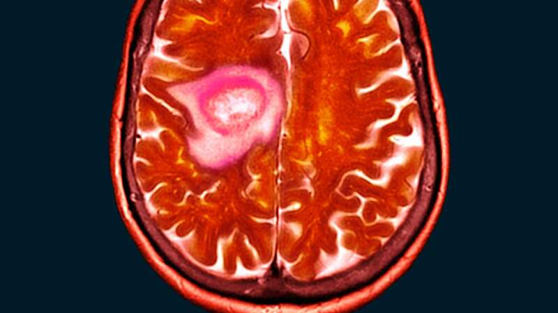 Every year, roughly 3,200 people are diagnosed with GBM. (Image: Getty Images/Science Photo Library RF)
