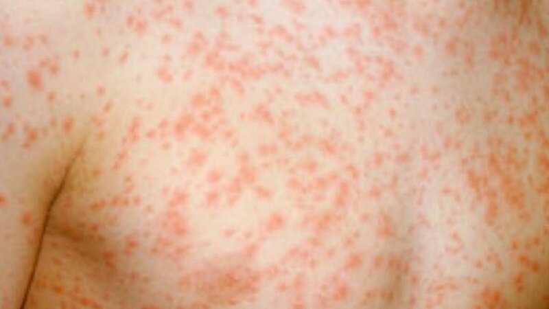 A rash will develop if you contract measles (Image: UK Health Security Agency (UKHSA))