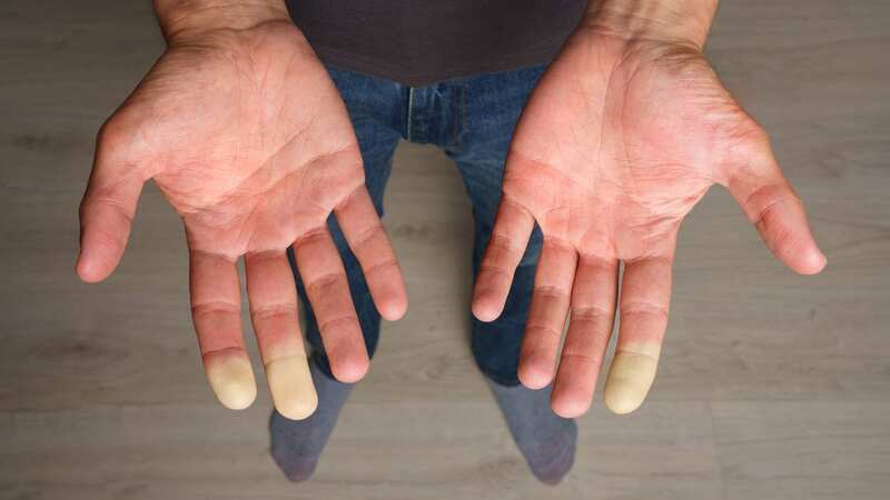 Millions of people suffer with Raynaud’s phenomenon, a heritable condition that affects blood circulation (Image: Getty Images/iStockphoto)