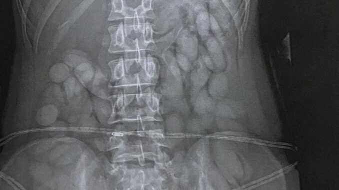 X-ray reveals ’cocaine bullets’ found in stomach of woman stopped at airport