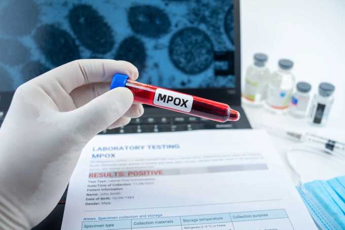 New case of mpox variant Clade Ib reported in England