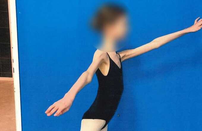 Cruel parents starved their teen ballerina daughter until she weighed only 4 stone