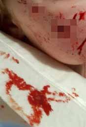 Injuries sustained by children from dogs in Yorkshire. Photo released February 7 2025. A shocking photo shows a teenage girl’s injuries from a horror dog attack - after two other children were also mauled by the animals nearby just days later. South Yorkshire Police say they were called to a property in Rossington, South Yorks., where a 16-year-old girl was attacked by a Cane Corso. The girl had reconstruction surgery in hospital and a shocking photo shows a piece of skin hanging off her body.The dog was destroyed at the scene by firearms officers, with permission from the owner. qhxidiqxkiqrtinv