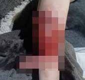 Injuries sustained by children from dogs in Yorkshire. Photo released February 7 2025. A shocking photo shows a teenage girl’s injuries from a horror dog attack - after two other children were also mauled by the animals nearby just days later. South Yorkshire Police say they were called to a property in Rossington, South Yorks., where a 16-year-old girl was attacked by a Cane Corso. The girl had reconstruction surgery in hospital and a shocking photo shows a piece of skin hanging off her body.The dog was destroyed at the scene by firearms officers, with permission from the owner.